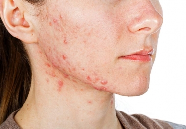 O que devo tomar para acne ?